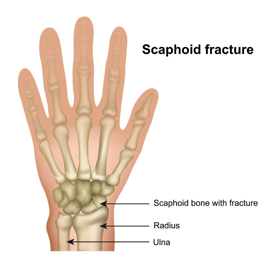 Scaphoid Fracture- Symptoms and Treatments 1
