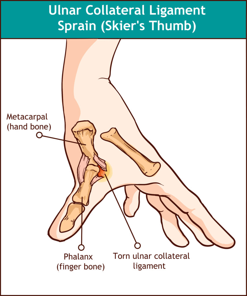 Ulnar Collateral Ligament Injuries of the Thumb 1