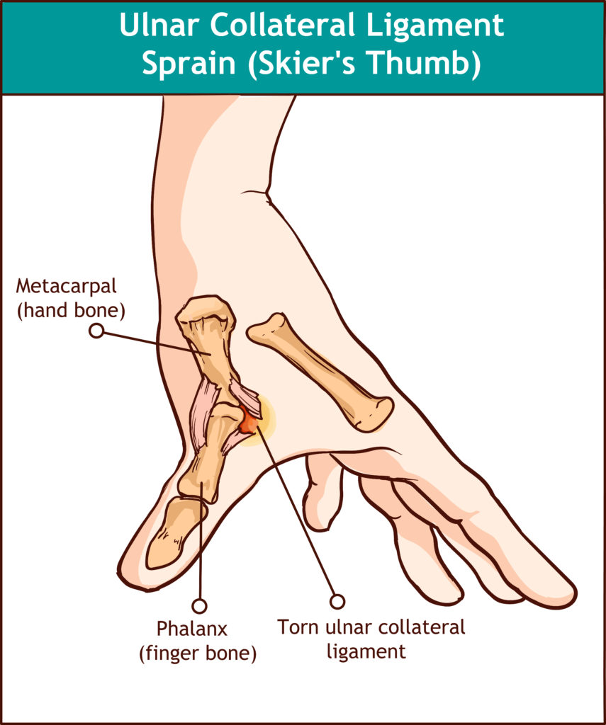 Ulnar Collateral Ligament Injuries of the Thumb | Panther Sports Medicine