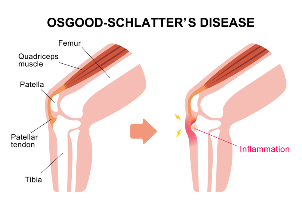 What is OsgoodSchlatter’s Disease? Panther Sports Medicine