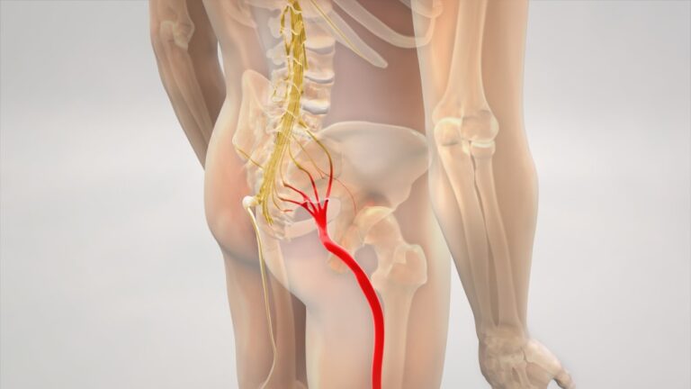 What is a Sciatic Nerve Pain? | Panther Sports Medicine