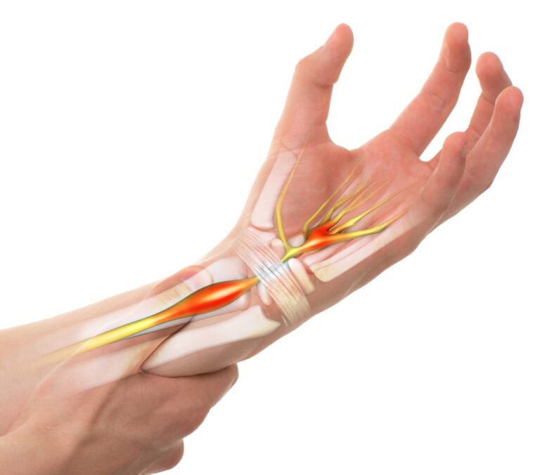 Tendonitis in the Wrist | Panther Sports Medicine
