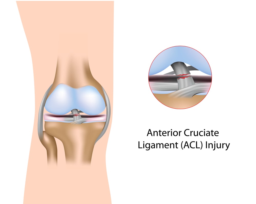 Guide on ACL Injury